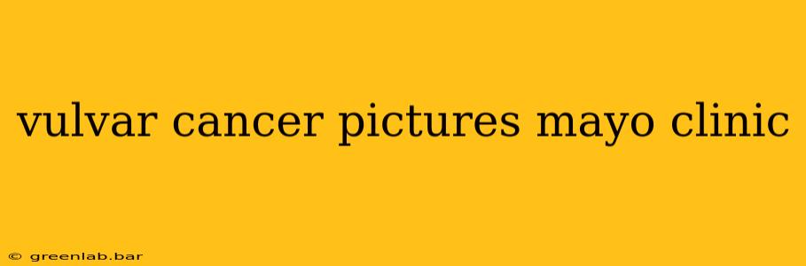 vulvar cancer pictures mayo clinic